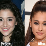 Ariana Grande Plastic Surgery Before and After Photos
