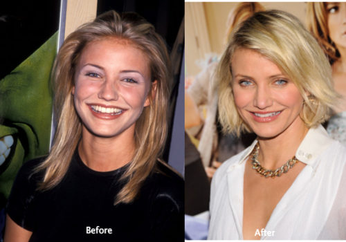 Cameron Diaz Plastic Surgery Before and After Photos