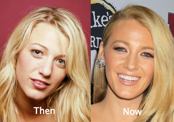 Blake Lively Plastic Surgery Before and After nose job - Latest Plastic Sur...