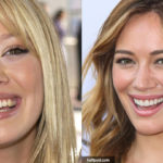 Hilary Duff Teeth Veneers Before and After