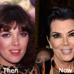 Kris Jenner Plastic Surgery on Hand Before and After