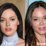 Rose McGowan Plastic Surgery Before and After Photos