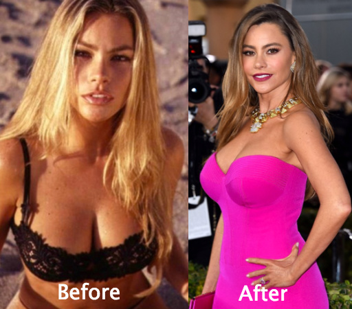 Sofia Vergara plastic surgery is about her boob job, liposuction and faceli...