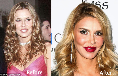 Brandi Glanville Plastic Surgery Before and After Photos