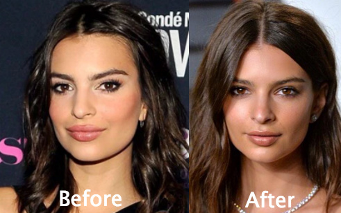 Emily Ratajkowski Plastic Surgery Before and After