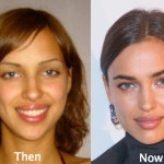 Irina Shayk Plastic Surgery Before and After Photos