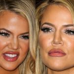 Khloe Kardashian Facial Fillers Revealed