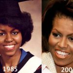 Michelle Obama Plastic Surgery Before and After Photos