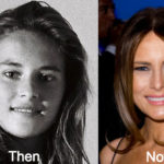 Melania Trump Plastic Surgery Before and After Photos