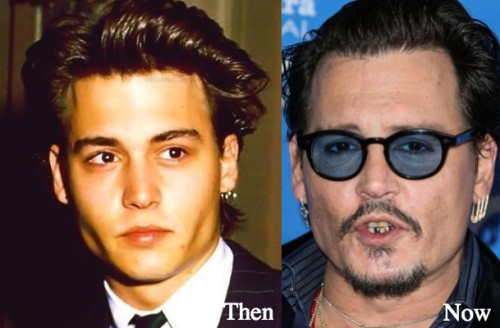 Johnny Depp Plastic Surgery Before and After Photos
