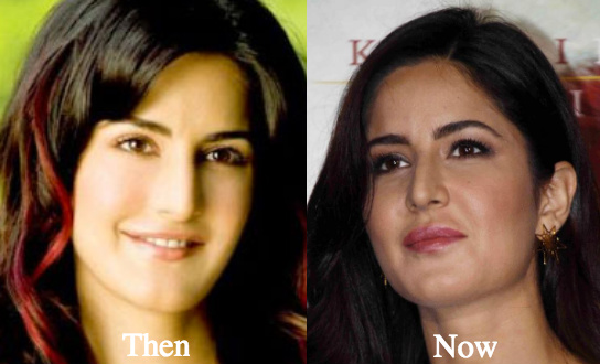Katrina Kaif lip and cheek fillers - Latest Plastic Surgery Gossip And  News. Plastic Surgery Tips and Advice