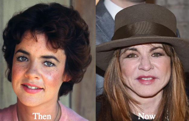Stockard Channing Plastic Surgery Before and After Photos.
