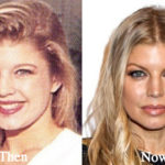 Fergie Plastic Surgery Before and After Photos