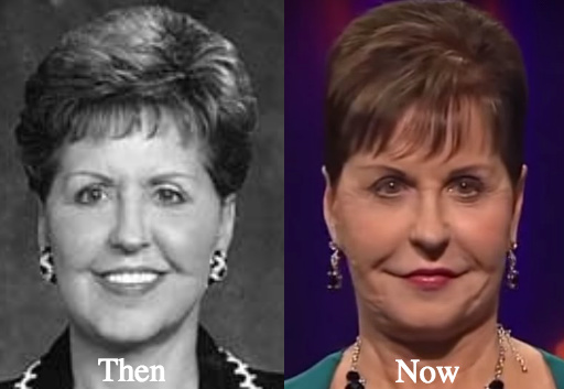 Joyce Meyer Plastic Surgery before and after photos. 