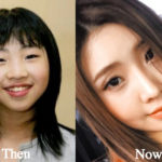 Minzy Plastic Surgery Before and After Photos
