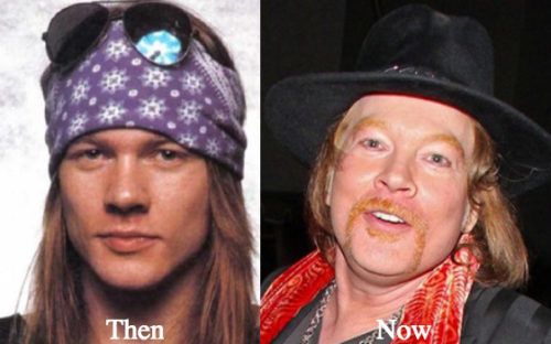 Axl Rose Plastic Surgery Before and After Photos - Latest Plastic ...
