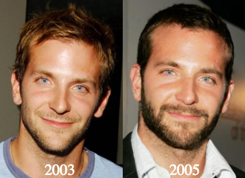 Bradley Cooper Plastic Surgery Before and After Photos
