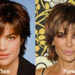 Lisa Rinna Plastic Surgery Before and After Photos