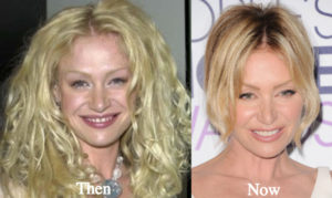 Portia de Rossi Plastic Surgery Before and After Photos - Latest ...
