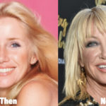 Suzanne Somers Plastic Surgery Before and After Photos