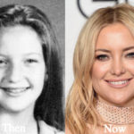 Kate Hudson Plastic Surgery Before and After Photos