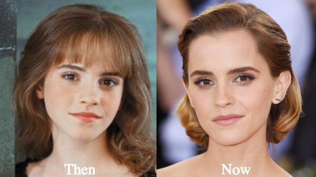 Did Emma Watson have a boob job and a nose job? 