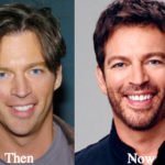 Harry Connick Jr Plastic Surgery Before and After Photos