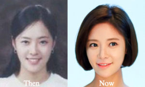 uhm jung hwa plastic surgery Image 9