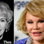 Joan Rivers Plastic Surgery Before and After Photos