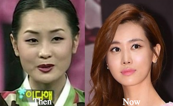 Did Lee Da Hae Undergo Plastic Surgery? 