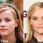 Reese Witherspoon Plastic Surgery Before and After Photos