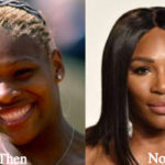 Serena Williams Plastic Surgery Before and After Photos
