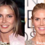Heidi Klum Plastic Surgery Before and After Photos