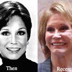 Mary Tyler Moore Plastic Surgery Before and After Photos