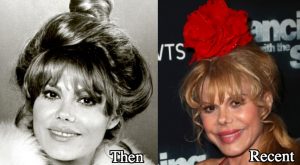 Charo Plastic Surgery Before and After Photos