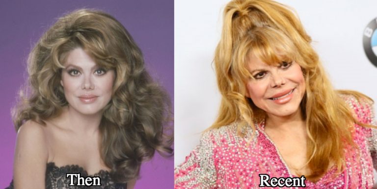 Charo Plastic Surgery Before and After Photos - Latest Plastic Surgery ...