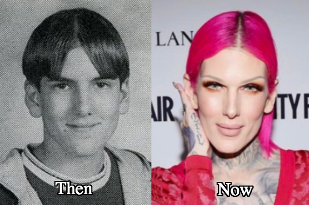Jeffree Star and Lip Fillers.