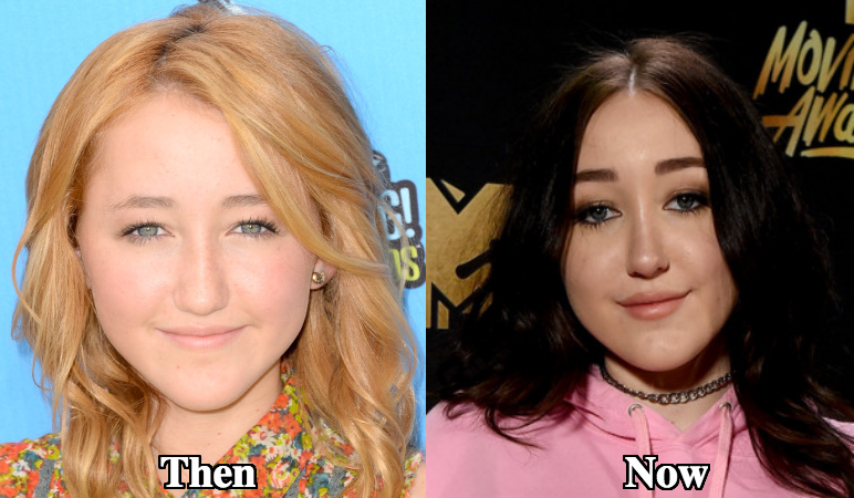 Noah Cyrus lip fillers before and after photos.