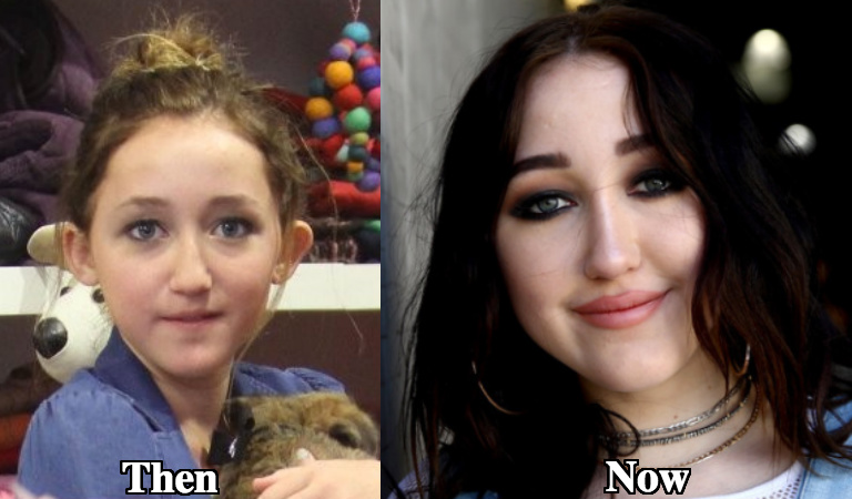 Noah Cyrus nose job before and after photos.