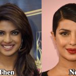 Priyanka Chopra Plastic Surgery Before and After Photos