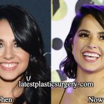 Becky G Teeth Surgery Transformation – Before and After Photos