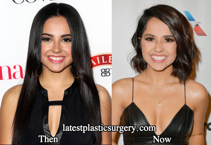 Did becky g get teeth gap removed? 