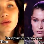 Bella Hadid Nose Job – Did She Undergo Rhinoplasty?