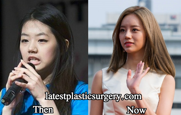 Hyeri double eyelid surgery before and after - Latest Plastic Surgery Gossi...