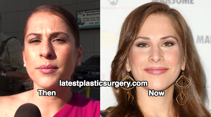 Ana Kasparian Nose Job - Is her Nose Real? 