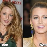 Blake Lively Nose Job Before and After Photos